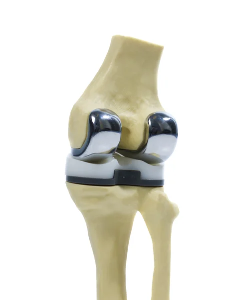 Plastikmodell eines Kniegelenkersatzes lizenzfreie Stockfotos