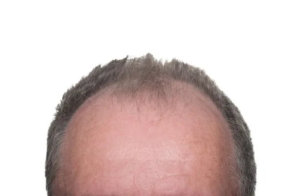 Male Pattern Baldness — Stock Photo, Image