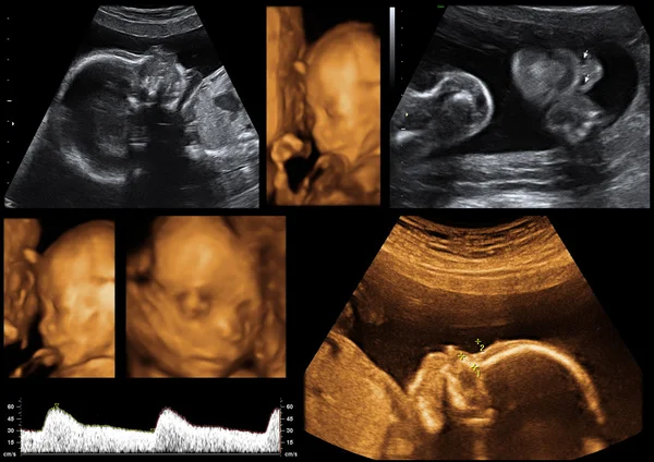 Ultrasonographic Photos from a Baby — Stock Photo, Image