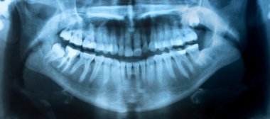 Diş röntgeni panoramik
