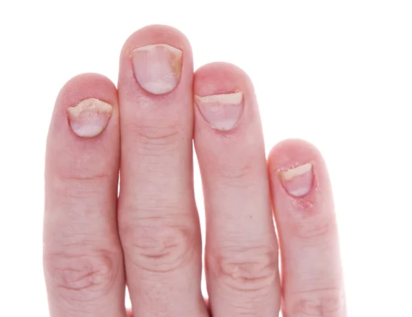 Psoriasis sur ongles isolés fond blanc — Photo
